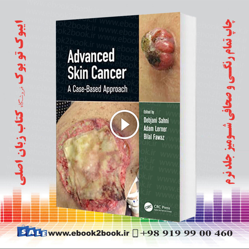 Advanced Skin Cancer: A Case-Based Approach