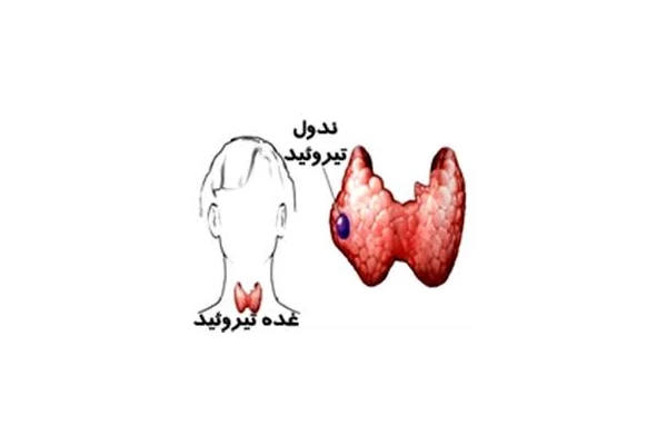 فایل اپروچ (برخورد) به ندول تیرویید - کتابخانه مجازی واتیکان