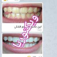  سفیدکننده دندان