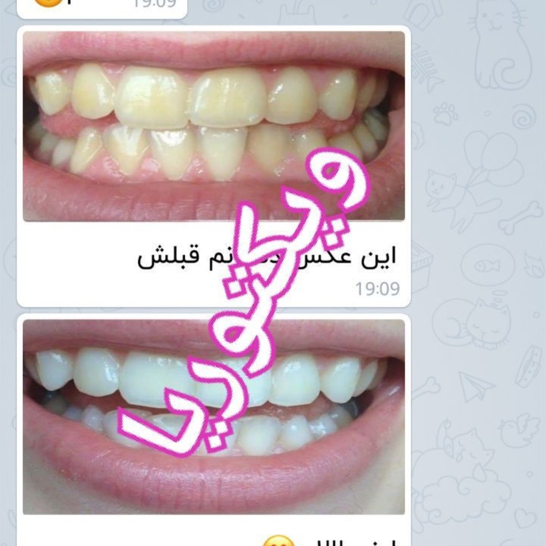 سفیدکننده دندان