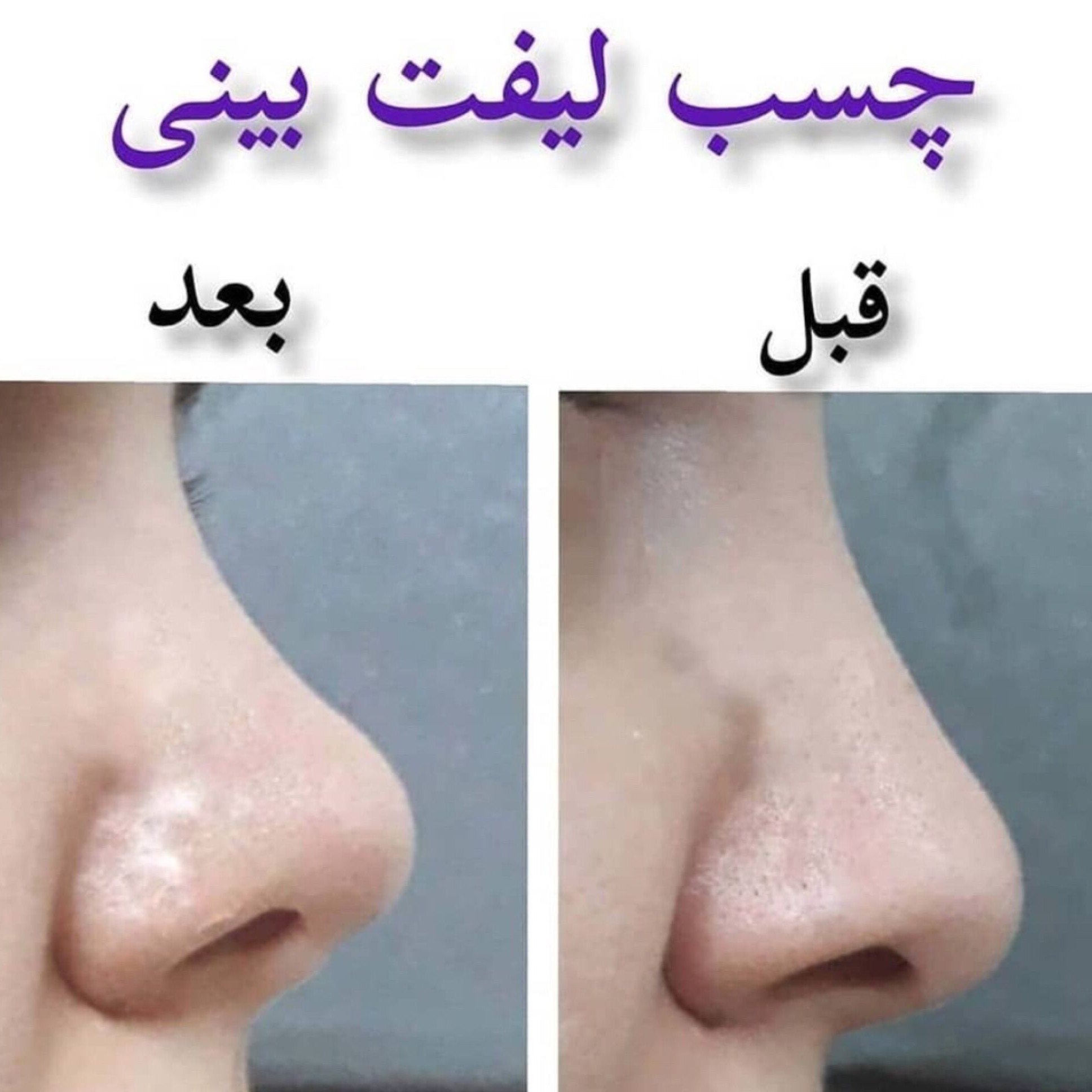چسب لیفت بینی