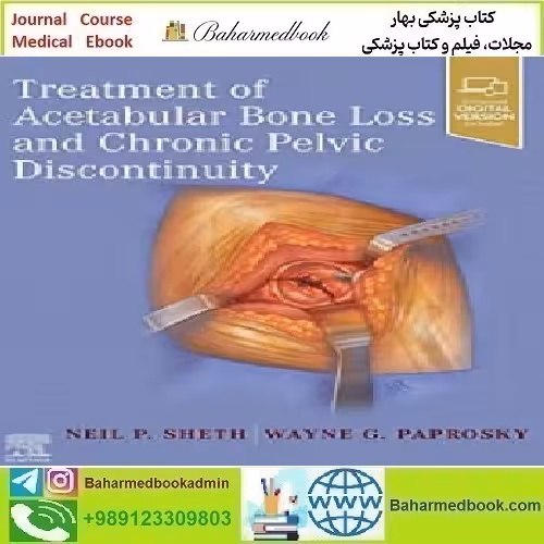 Treatment of Acetabular Bone Loss and Chronic Pelvic Discontinuit