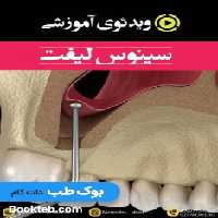 ویدئوی آموزشی سینوس لیفت (انگلیسی)
