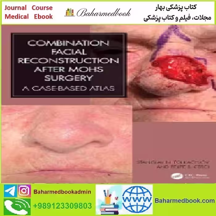Combination Facial Reconstruction after Mohs Surgery TRUE PD