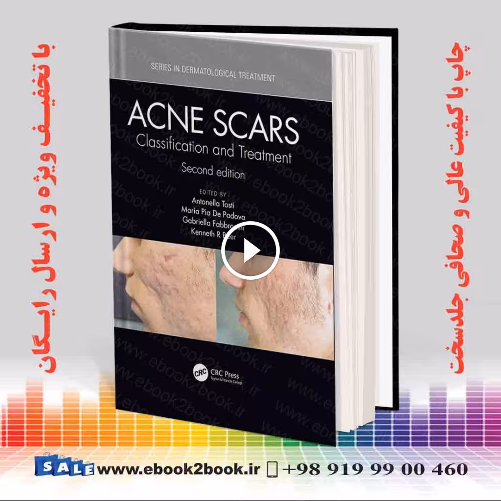 Acne Scars: Classification and Treatment 2nd Edition