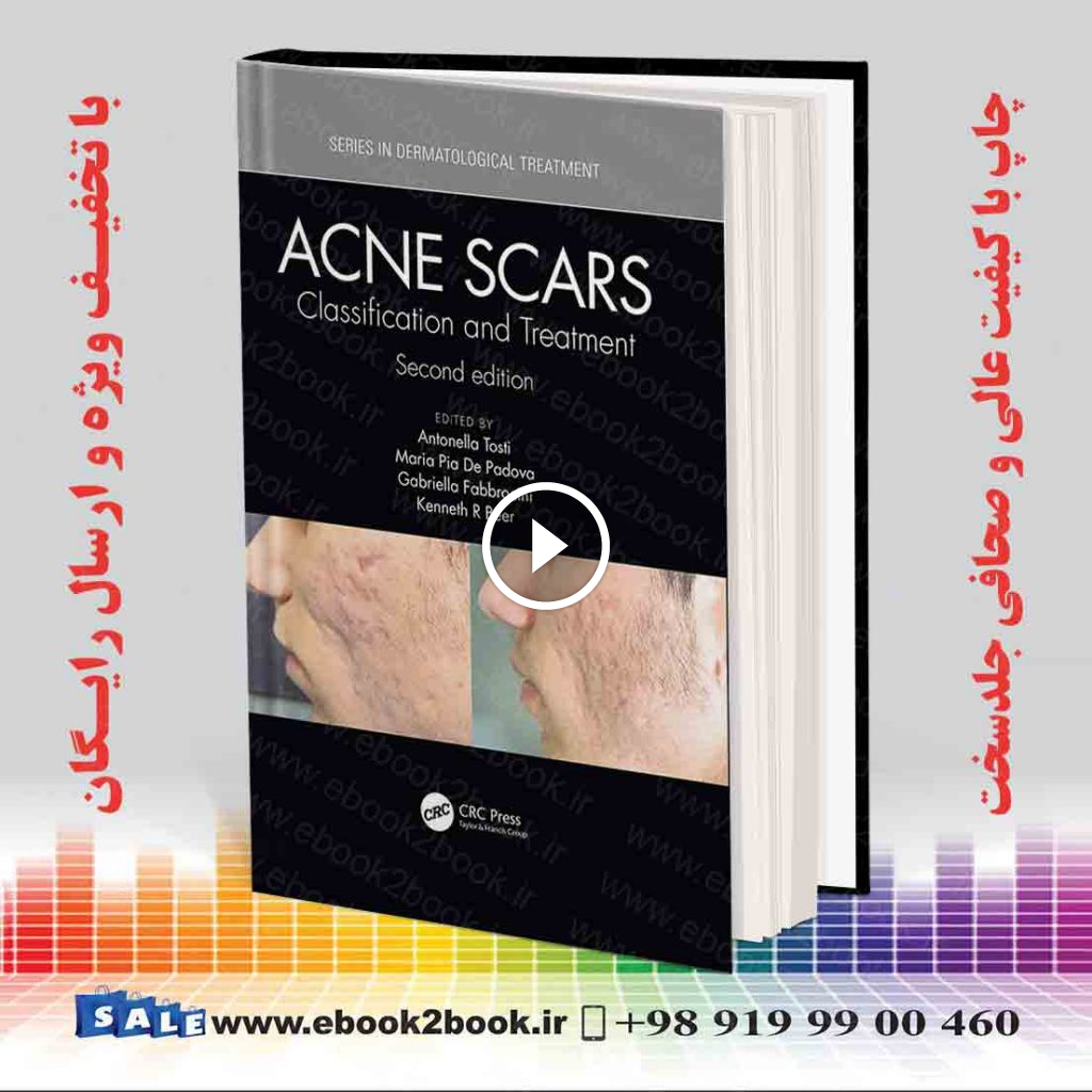 Acne Scars: Classification and Treatment 2nd Edition