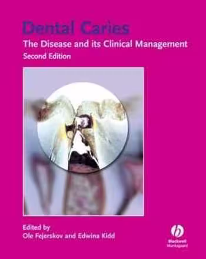 [PDF] دانلود کتاب Dental Caries - The Disease And Its Clinical Management, 2nd ed, 2003