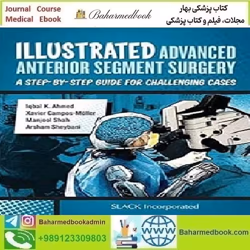 Illustrated Advanced Anterior Segment Surgery 2021