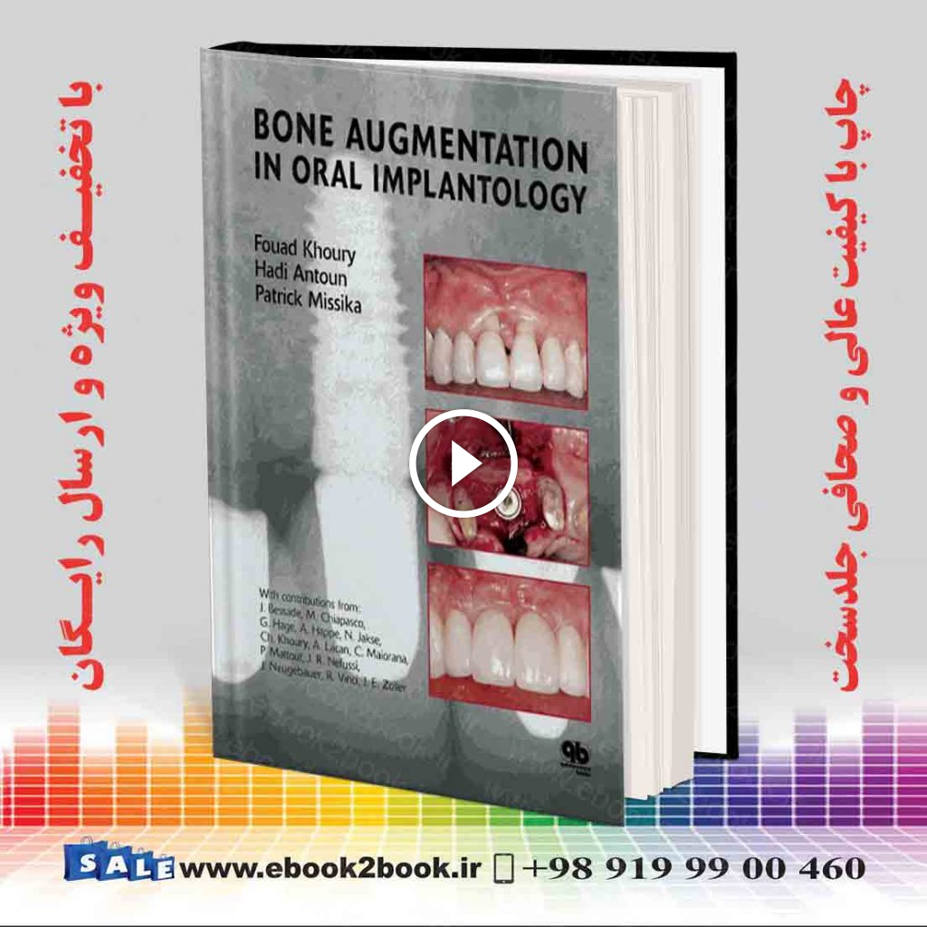 Bone Augmentation in Oral Implantology