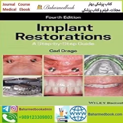 Implant Restorations A Step by Step Guide 2020 TRUE
