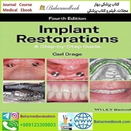 Implant Restorations A Step by Step Guide 2020 TRUE