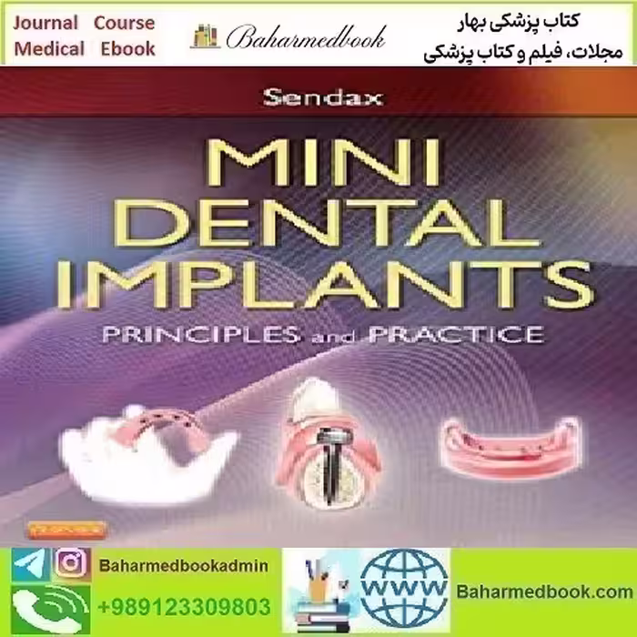Mini Dental Implants Principles and Practice 2013 T