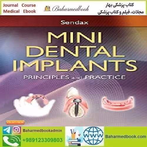 Mini Dental Implants Principles and Practice 2013 T