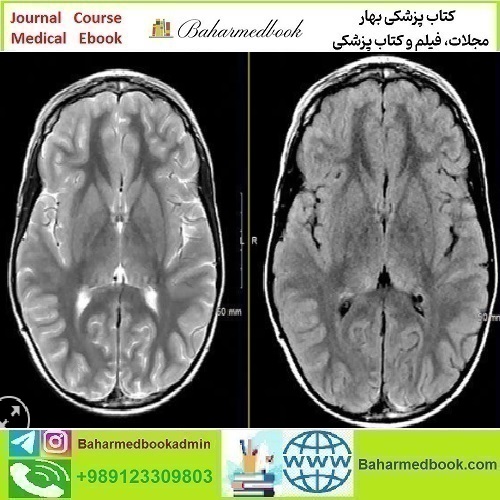 MRIOnline Mastery Series Neurofibromatosis Type 1 NF1 2021 v