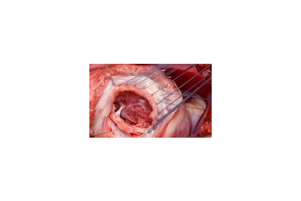 اطلاعات جامع درباره ترمیم و تعویض دریچه های قلبی - کتابخانه مجازی واتیکان