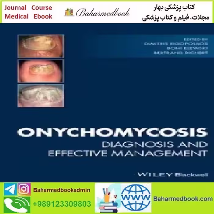 Onychomycosis Diagnosis and Effective Management TRUE PDF