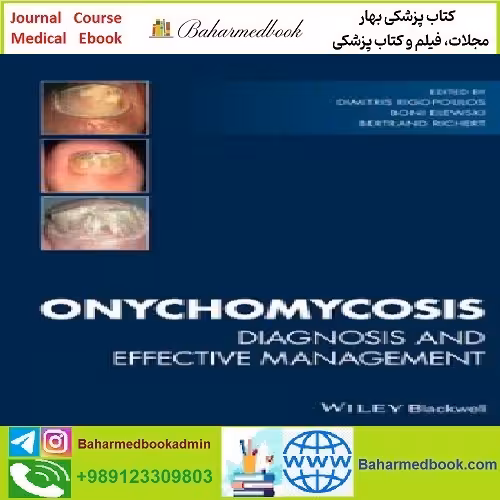 Onychomycosis Diagnosis and Effective Management TRUE PDF