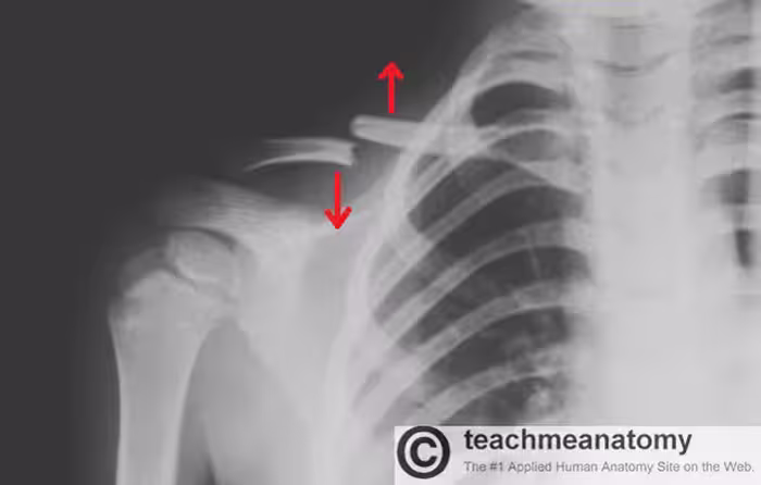 دانلود پاورپوینت بررسی شکستگی ها