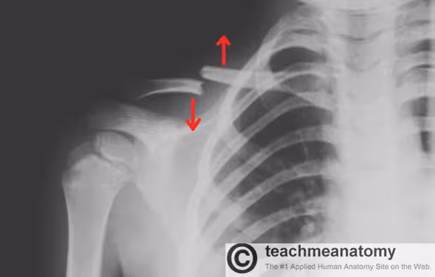 دانلود پاورپوینت بررسی شکستگی ها