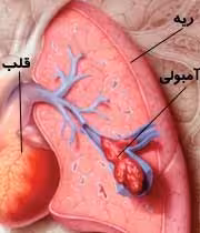 آمبولی ریه