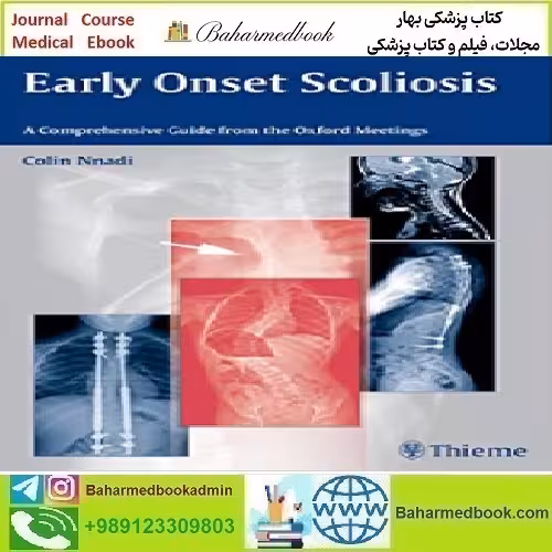 Early Onset Scoliosis A Comprehensive Guide
