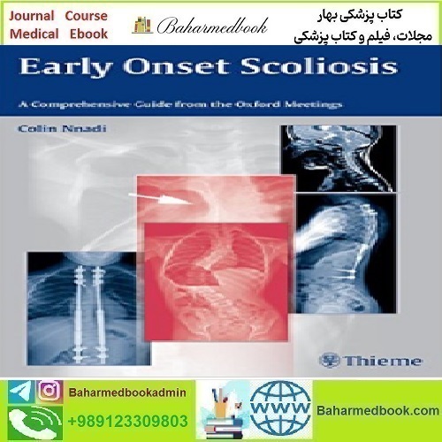 Early Onset Scoliosis A Comprehensive Guide