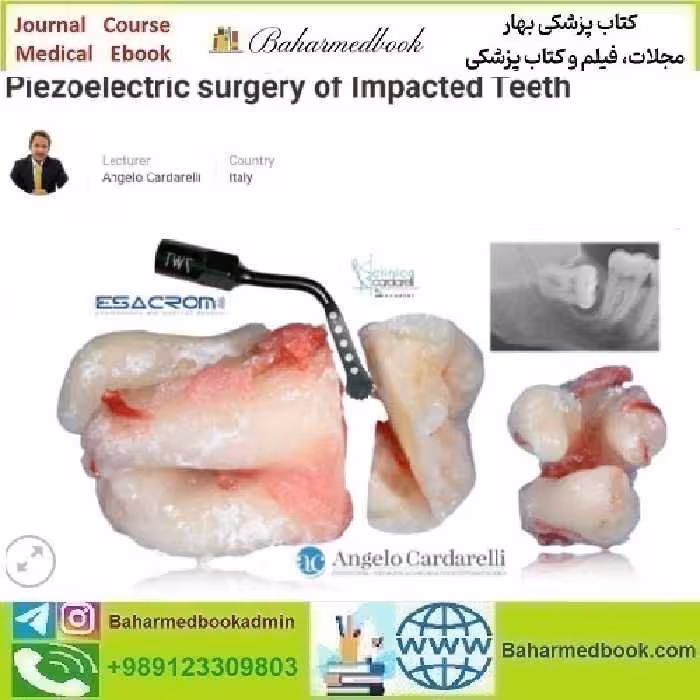 Piezoelectric Surgery of Impacted Teeth 2021 By Angelo Cardarel