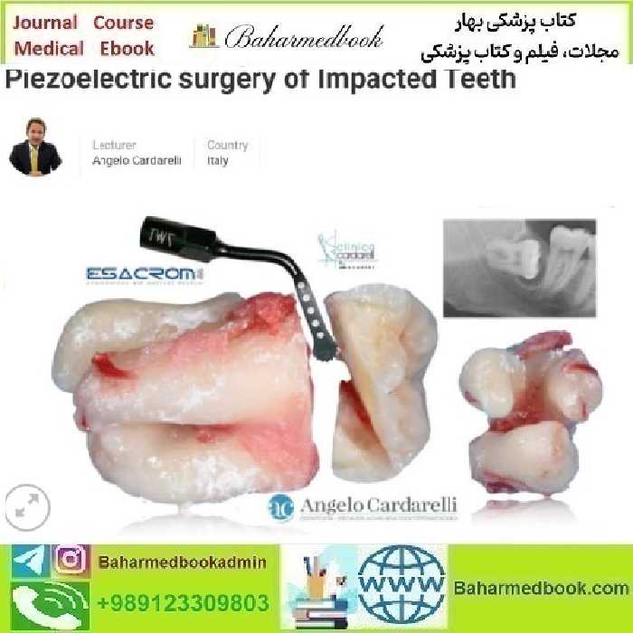 Piezoelectric Surgery of Impacted Teeth 2021 By Angelo Cardarel