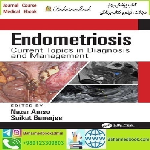 Endometriosis Current Topics in Diagnosis and Management 2022