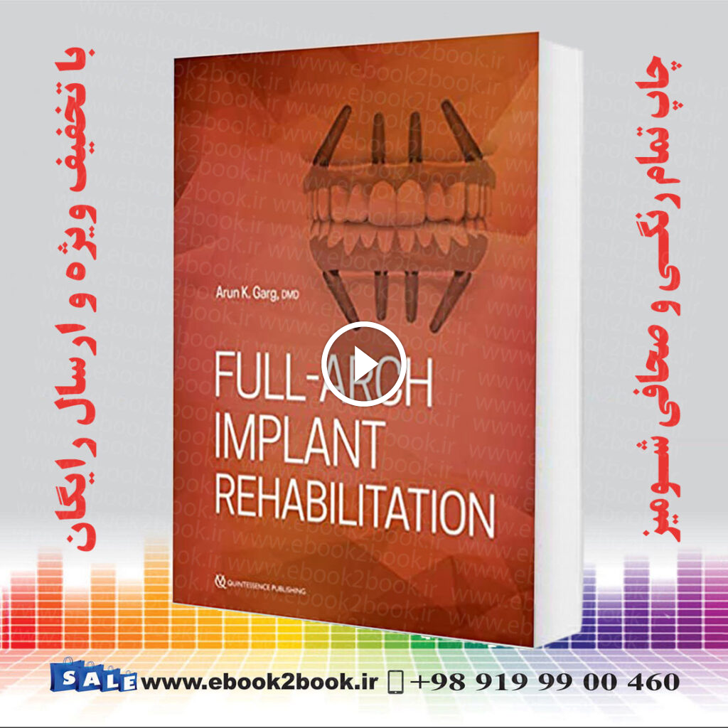 Full-Arch Implant Rehabilitation