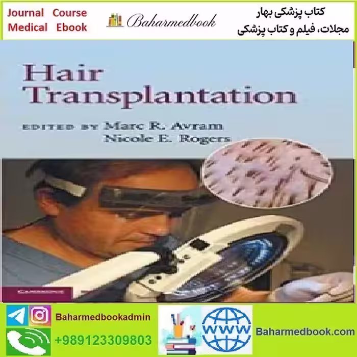 Hair Transplantation TRUE PDF price 1€ - کتاب پزشکی بهار