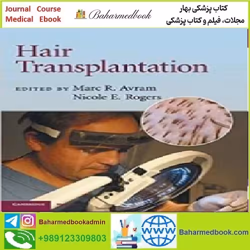 Hair Transplantation TRUE PDF price 1€ - کتاب پزشکی بهار