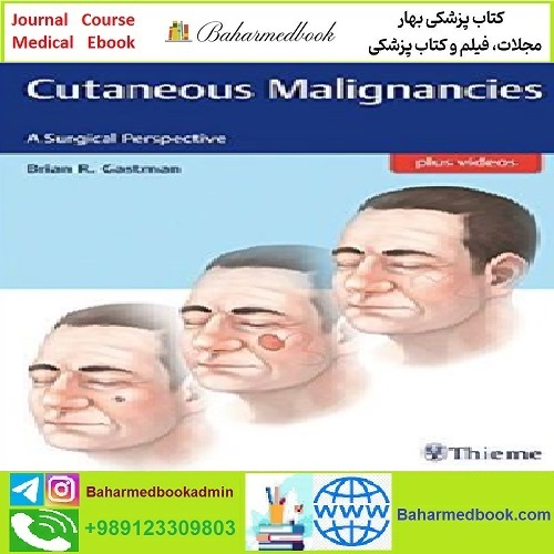 Cutaneous Malignancies TRUE PDF price 1€ - کتاب پزشکی بهار