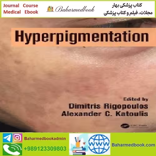 Hyperpigmentation TRUE PDF price 1€ - کتاب پزشکی بهار