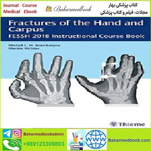 Fractures of the Hand and Carpus TRUE PDF price 1€
