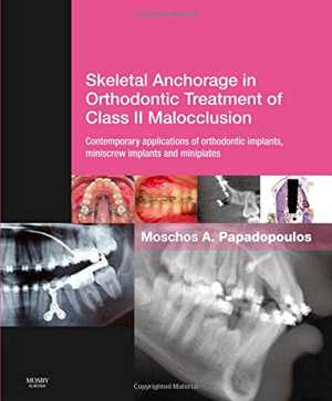 [PDF] دانلود کتاب Skeletal Anchorage In Orthodontic Treatment Of Class II Malocclusion - Contemporary Applications Of Orthodontic Implants, Miniscrew Implantsand Mini Plates, 1E, 2015