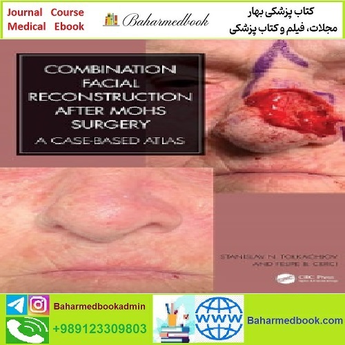 Combination Facial Reconstruction after Mohs Surgery TRUE P