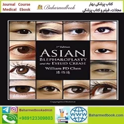 Asian Blepharoplasty and the Eyelid Crease 2016 TRUE P