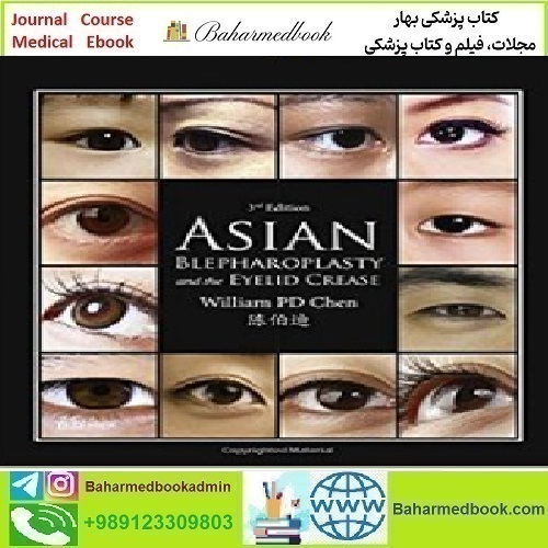 Asian Blepharoplasty and the Eyelid Crease 2016 TRUE P