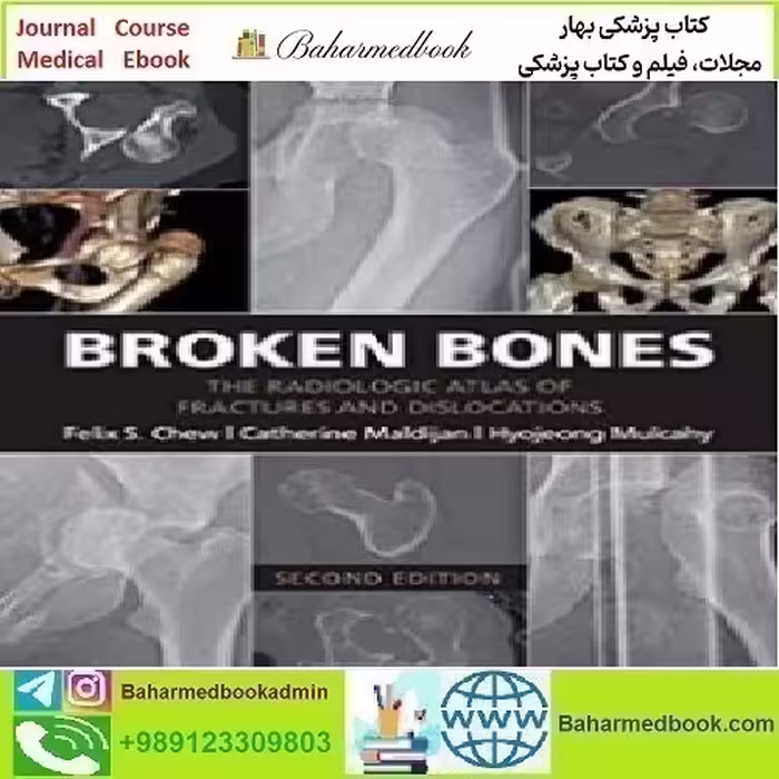Broken Bones The Radiologic Atlas of Fractures and Dislocations