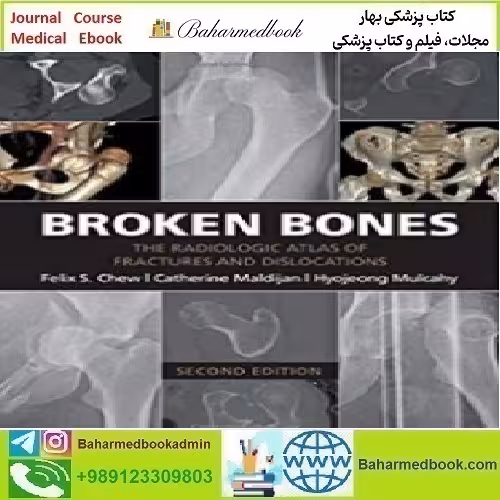 Broken Bones The Radiologic Atlas of Fractures and Dislocations
