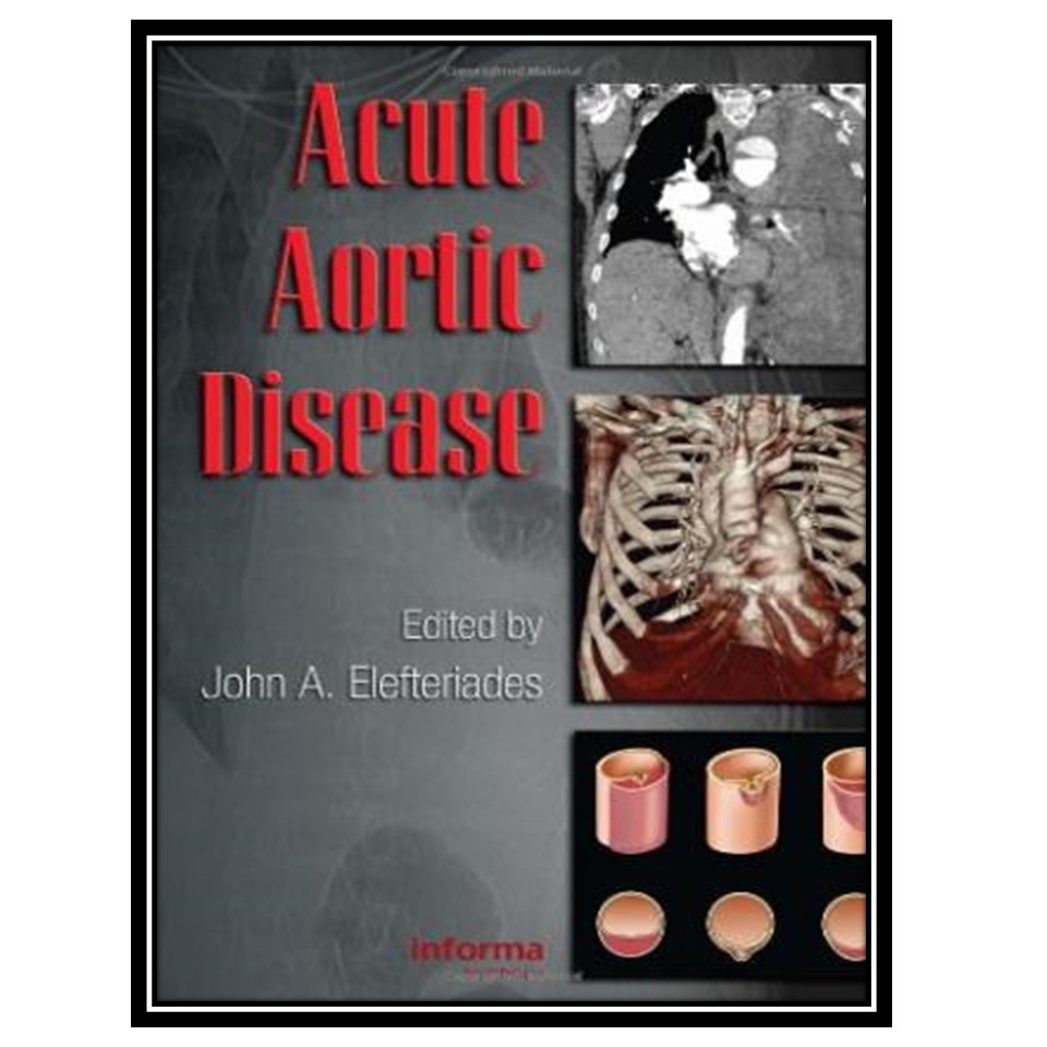 کتاب Acute aortic disease اثر Elefteriades John انتشارات مؤلفین طلایی