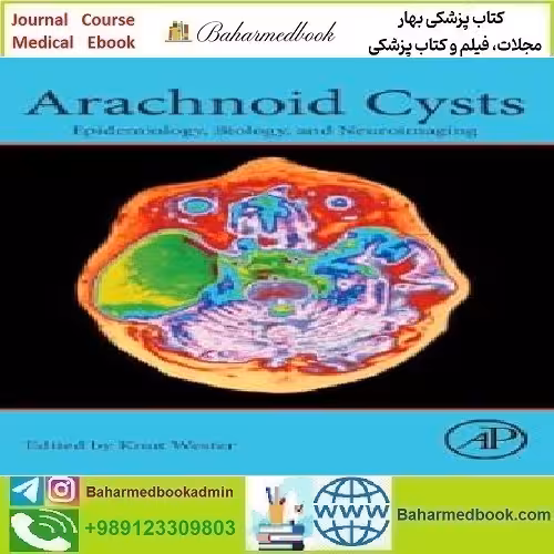 Arachnoid Cysts Epidemiology Biology and Neuroimaging 2018