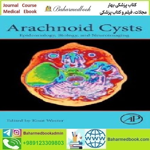 Arachnoid Cysts Epidemiology Biology and Neuroimaging 2018
