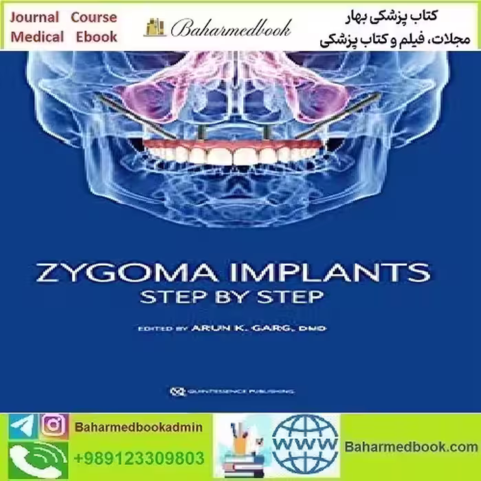 Zygoma Implants Step by Step 2023 TRUE PDF price 5€ - کتاب پزشکی بهار