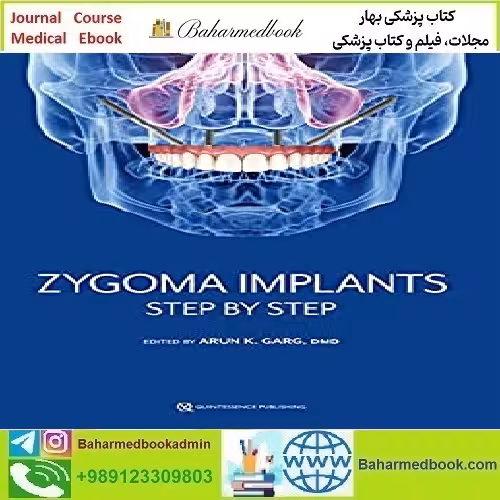 Zygoma Implants Step by Step 2023 TRUE PDF price 5€ - کتاب پزشکی بهار