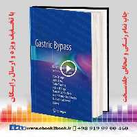 Gastric Bypass