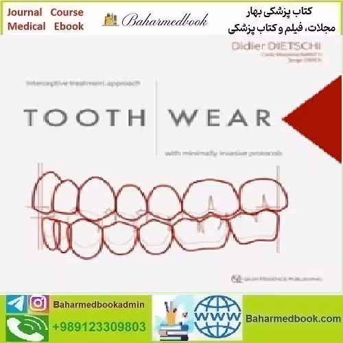 Tooth Wear Interceptive Treatment Approach With Minimally