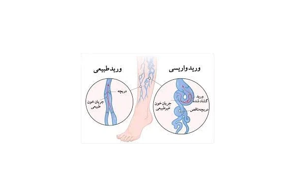 جزوه بیماری های وریدی venous disease دانشگاه علوم پزشکی تهران - کتابخانه مجازی واتیکان