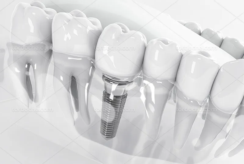 عکس ایمپلنت باکیفیت | گرافیک با طعم تربچه